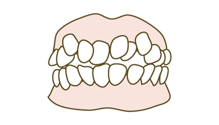 当院の虫歯治療について