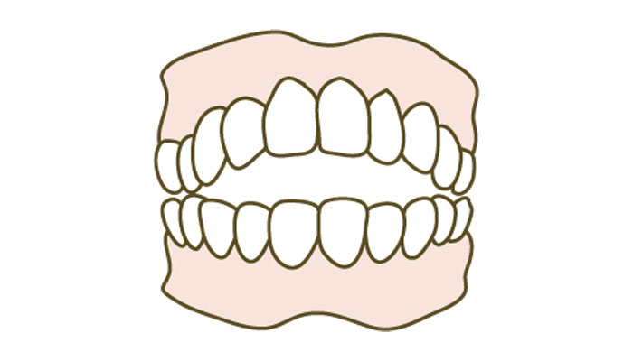 当院の虫歯治療について