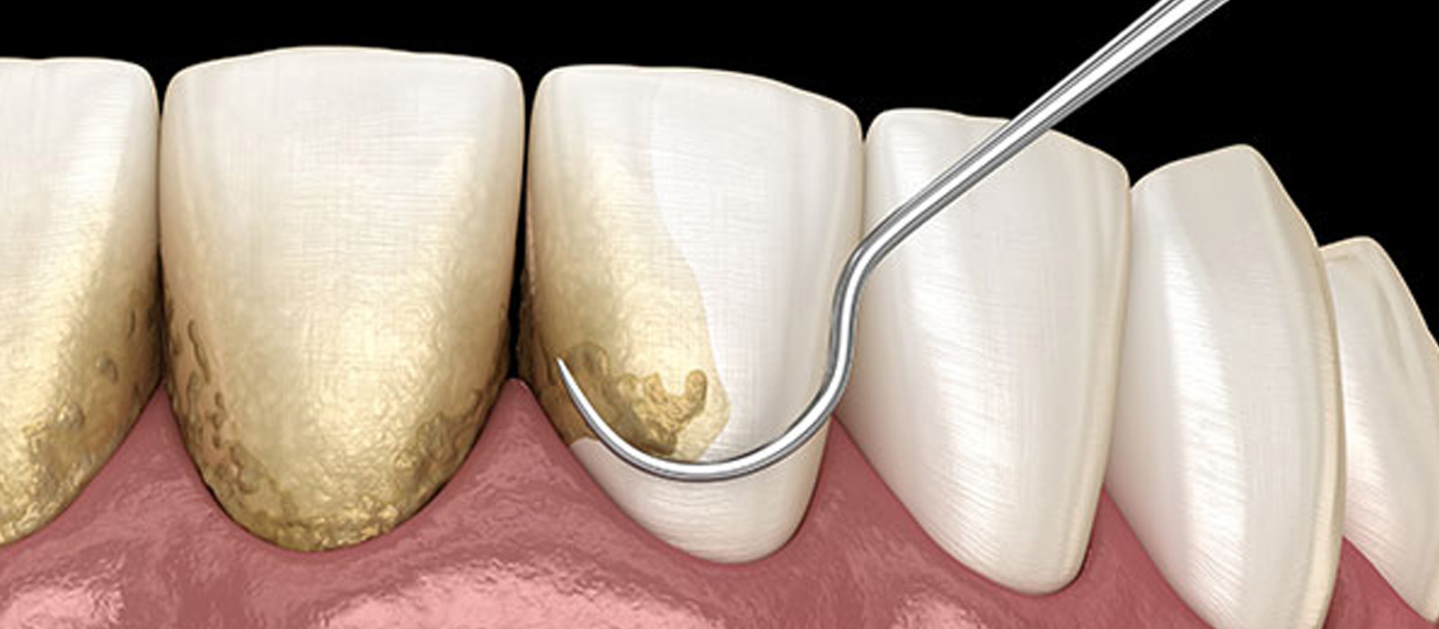 歯周病の原因と症状