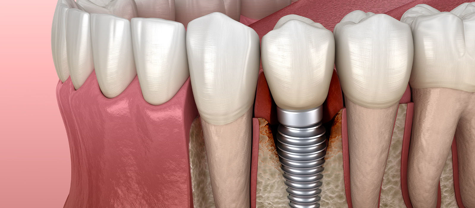 手術後半年〜数年後に出る腫れ