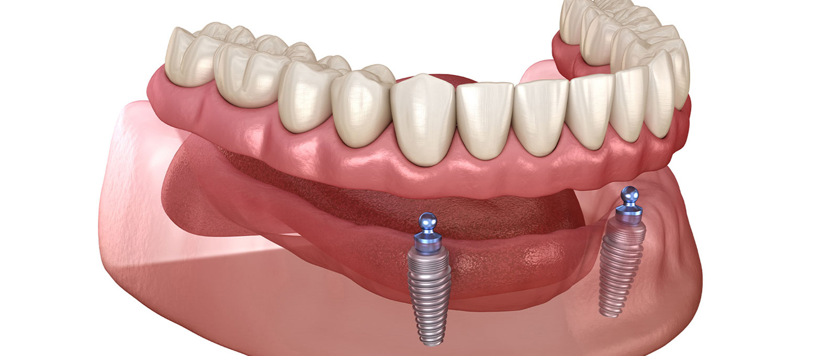 インプラントオーバーデンチャーとオールオン4の違いをわかりやすく比較