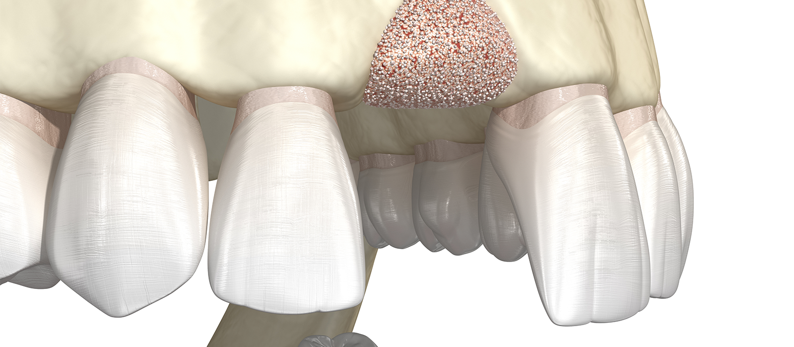 骨造成の主な治療方法