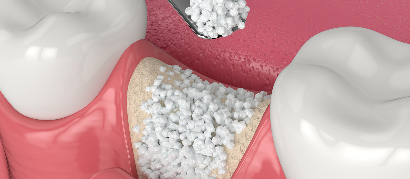 オールオン4や骨造成でインプラント治療が可能になることも