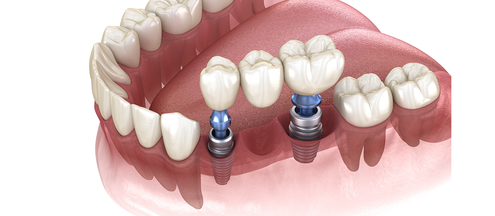 なぜインプラントを連結するのか