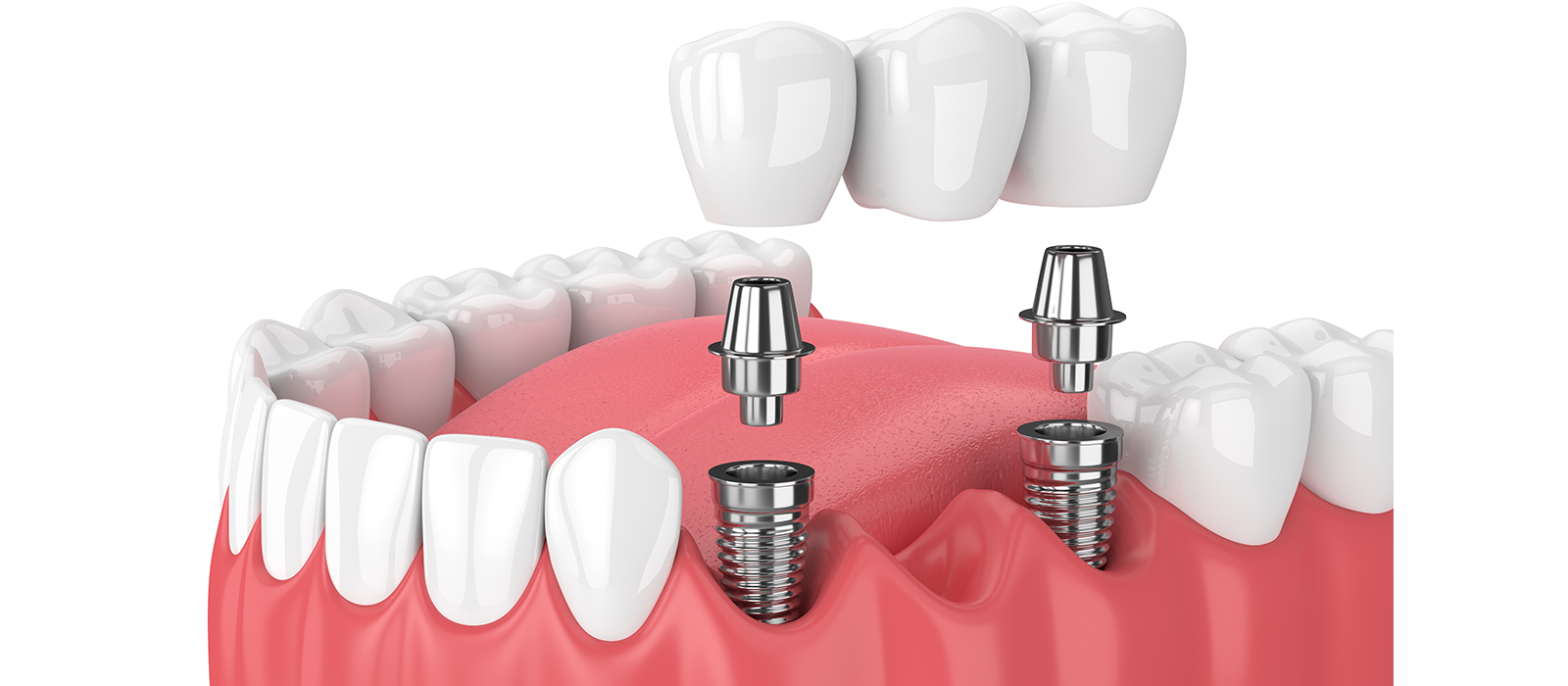 インプラント連結冠とは何か